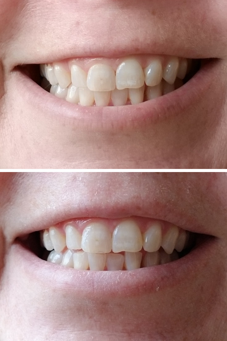 Affordable At Home Teeth Whitening for Coffee Stains Rural Mom