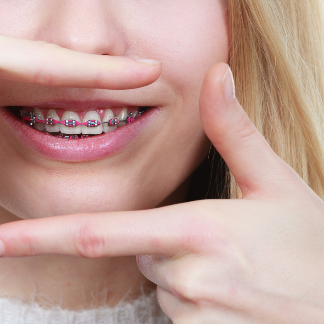 Dental Hygiene; Useful Tips For When Wearing Braces Rural Mom